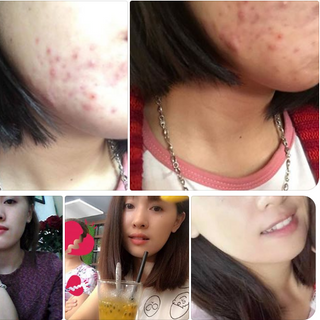 Kem trị mụn Tisha Ac7 Spot serum Top bán chạy nhất Hàn Quốc