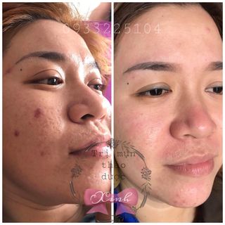 Thuốc Trị Mụn Thảo Dược Đông Y XINH