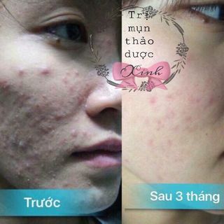 Thuốc Trị Mụn Thảo Dược Đông Y XINH