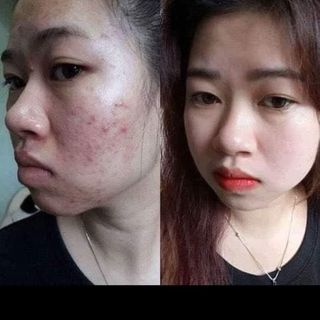TRỊ MỤN - NÁM - TÀN NHANG - DẦU NHỜN - SẸO RỖ - LỖ CHÂN LÔNG TO