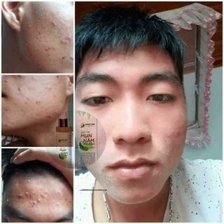 TRỊ MỤN - NÁM - TÀN NHANG - DẦU NHỜN - SẸO RỖ - LỖ CHÂN LÔNG TO