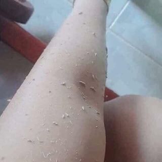 TẨY TBC QUYÊNLARA