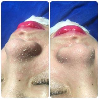 ủ mụn cám mụn đầu đen đáng ghét