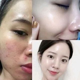 cao thảo mộc đặc trị mụn hiệu quả 100 chỉ 3k ngay