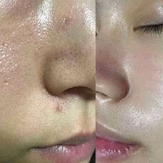 cao thảo mộc đặc trị mụn hiệu quả 100 chỉ 3k ngay