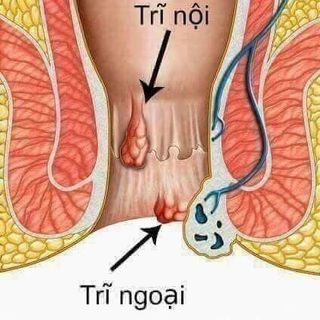 Thảo Mộc - Ngâm xông trĩ - Thanh Mộc Hương