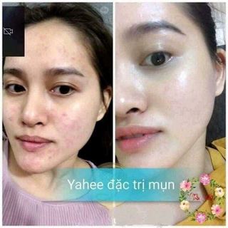 SET KEM TRỊ MỤN YANHEE THÁI LAN