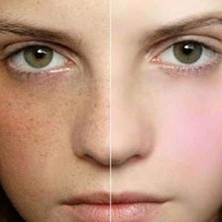 Serum siêu đặt trị ThâmNám tàn nhang