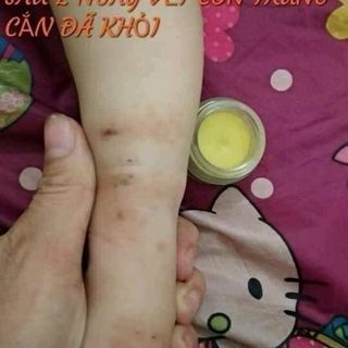 kem bôi da bách hợp Tiến Hạnh
