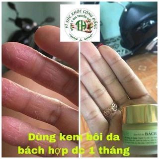 kem bôi da bách hợp Tiến Hạnh