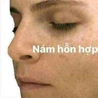 sét 3 món trị nám tàn nhang đốm nâu thái lan