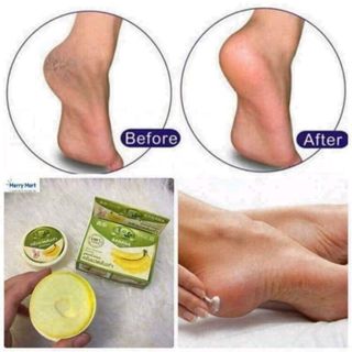 KEM CHUỐI TRỊ NỨT GÓT CHÂN CỦA THÁI