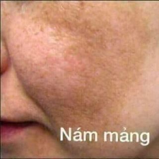 sét 5 món trị nám tàn nhang đốm nâu thái lan