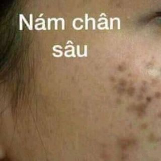 sét 5 món trị nám tàn nhang đốm nâu thái lan