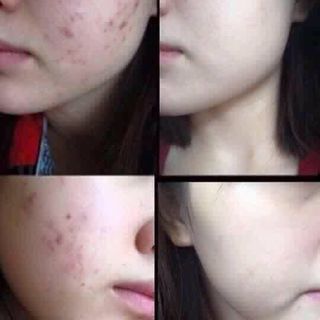 Serum trị mụn LINH CHI ĐỎ