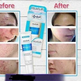 Kem Trị Mụn - YANHEE ACNE CREAM Thái Lan giá sỉ