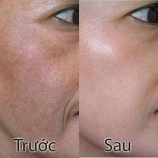 Kem Trị Nám