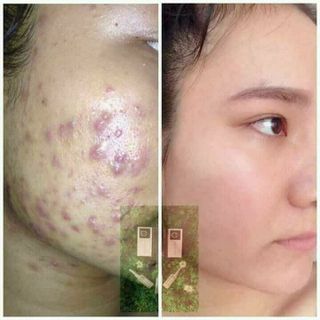 Kem trị mụn