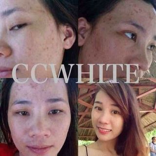 Kem trị mụn