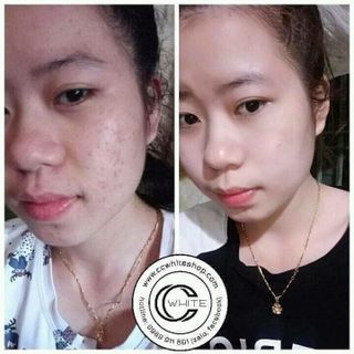 Kem trị mụn