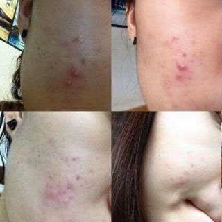 Kem Trị Sẹo Klirvin