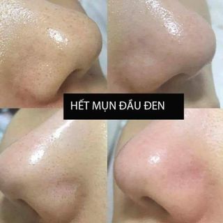 Trị mụn nám gia truyền