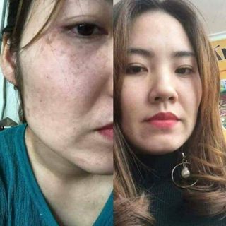 Trị mụn nám gia truyền