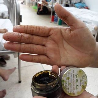 Viêm da cơ địa giá sỉ