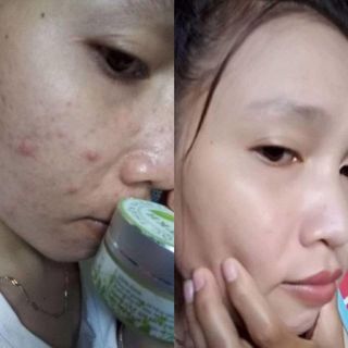 ĐẶC TRỊ MỤN DÂN TỘC DAO