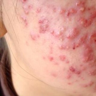 ĐẶC TRỊ MỤN DÂN TỘC DAO
