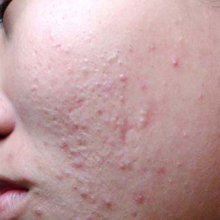 ĐẶC TRỊ MỤN DÂN TỘC DAO