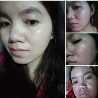 ĐẶC TRỊ MỤN DÂN TỘC DAO