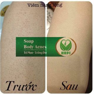 SOAP BODY ACNES trị mụn lưng ngực