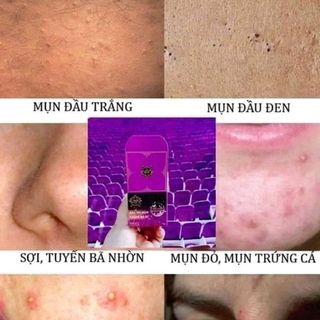 kem face trị mụn 2c
