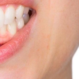 Tây Qua Sương Quế Lâm Chuyên Trị Nhiệt Miệng Lở Loét Miệng Viêm Nướu Chảy Máu Chân Răng