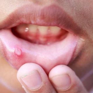Tây Qua Sương Quế Lâm Chuyên Trị Nhiệt Miệng Lở Loét Miệng Viêm Nướu Chảy Máu Chân Răng