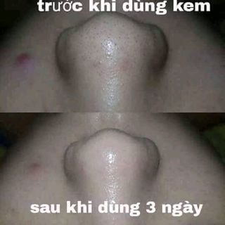 Kem trị mụn Acne ML
