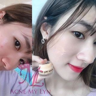 Kem trị mụn Acne ML