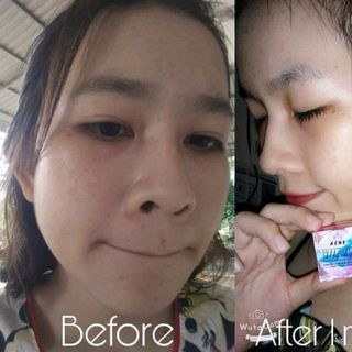Kem trị mụn Acne ML
