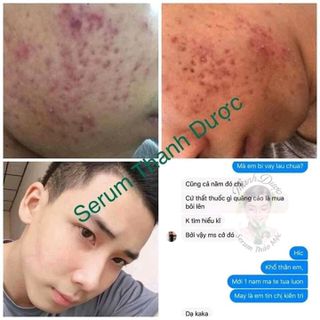 Thuốc Đặc trị Mụn