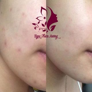 Trị mụn - Cao thảo mộc Ngọc Thiên Hương