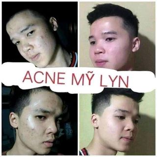 KEM TRỊ MỤN