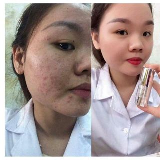 Gel Trị Mụn Cenlia