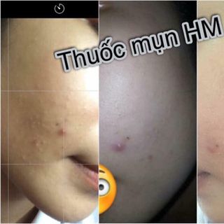 Thần Dược đặc trị mụn 7ngày