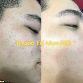 Thuốc đặc trị mụn siêu tốc