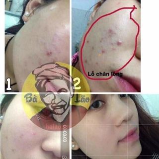 Trị mụn hỏa tốc BàLão