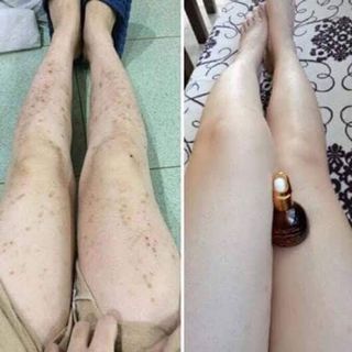 Tinh chất đặc trị thâm thiên nhiên Ngọc Thiên Hương