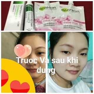 Nám thái túi clobetamil trị nám tàn nhang