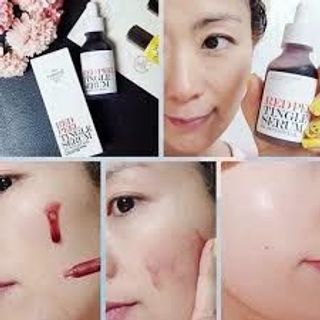 Tinh chất Red Peel Tingle Serum