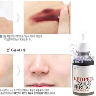 Tinh chất Red Peel Tingle Serum
